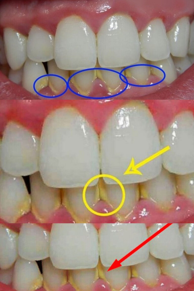 Jak usunąć kamień nazębny w 5 minut domowym sposobem, bez wizyty u dentysty